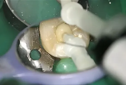 بناء أساس خلفي موثوق باستخدام UltraCore: حالة سريرية على السن رقم 37